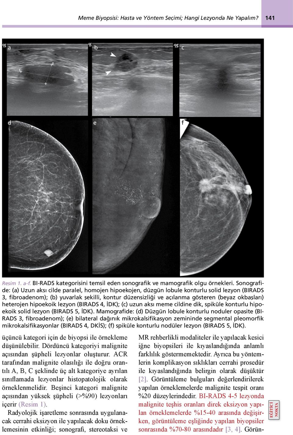 okbaşları) heterojen hipoekoik lezyon (BIRADS 4, İDK); (c) uzun aksı meme cildine dik, spiküle konturlu hipoekoik solid lezyon (BIRADS 5, İDK).