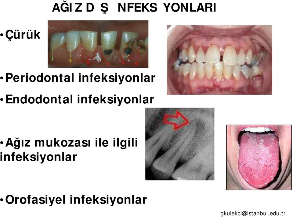 Endodontal infeksiyonlar Ağız