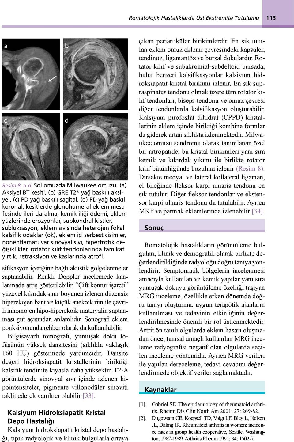 yüzlerinde erozyonlar, subkondral kistler, subluksasyon, eklem sıvısında heterojen fokal kalsifik odaklar (ok), eklem içi serbest cisimler, nonenflamatuvar sinovyal sıvı, hipertrofik değişiklikler,