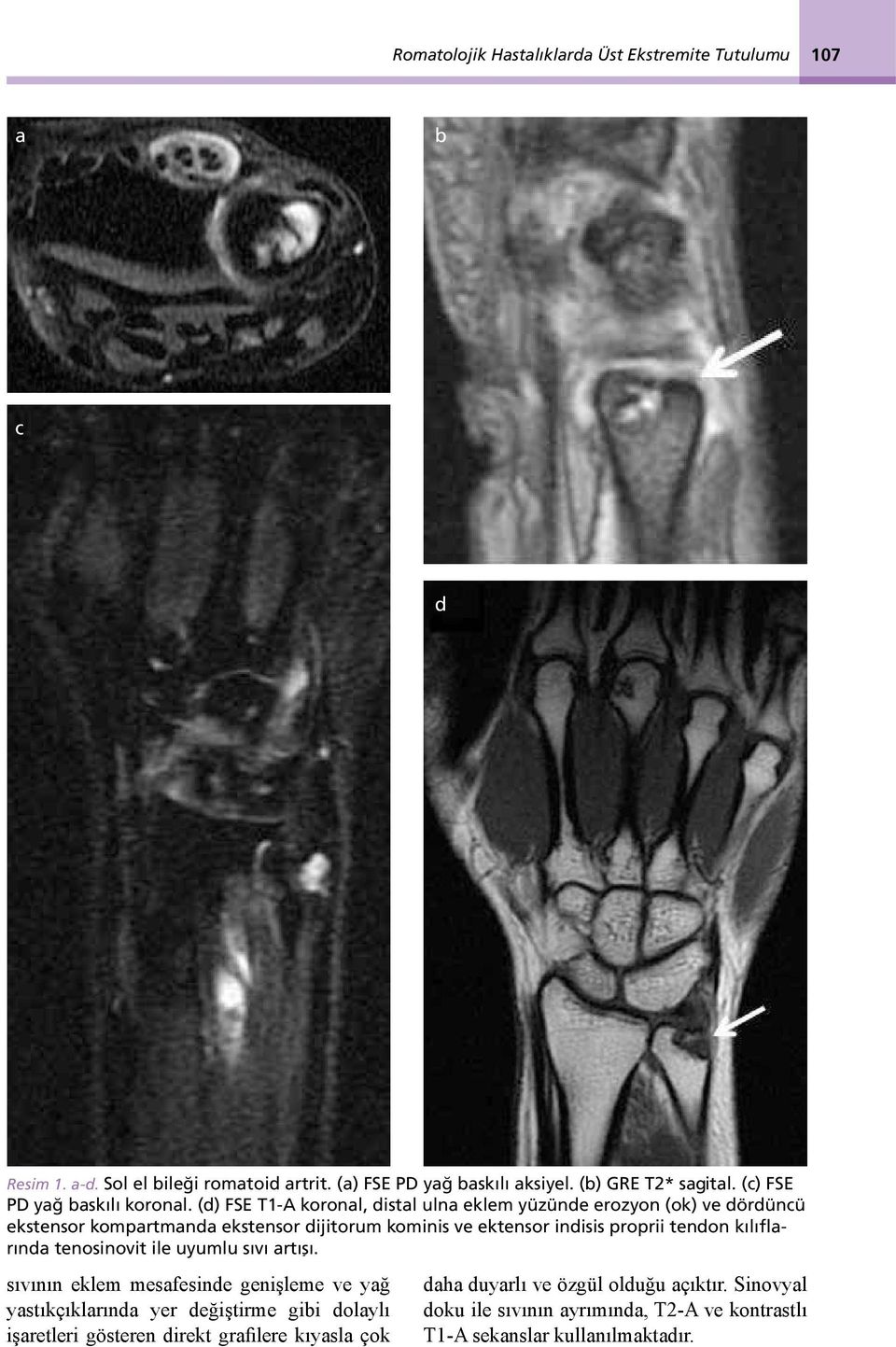 (d) FSE T1-A koronal, distal ulna eklem yüzünde erozyon (ok) ve dördüncü ekstensor kompartmanda ekstensor dijitorum kominis ve ektensor indisis proprii tendon