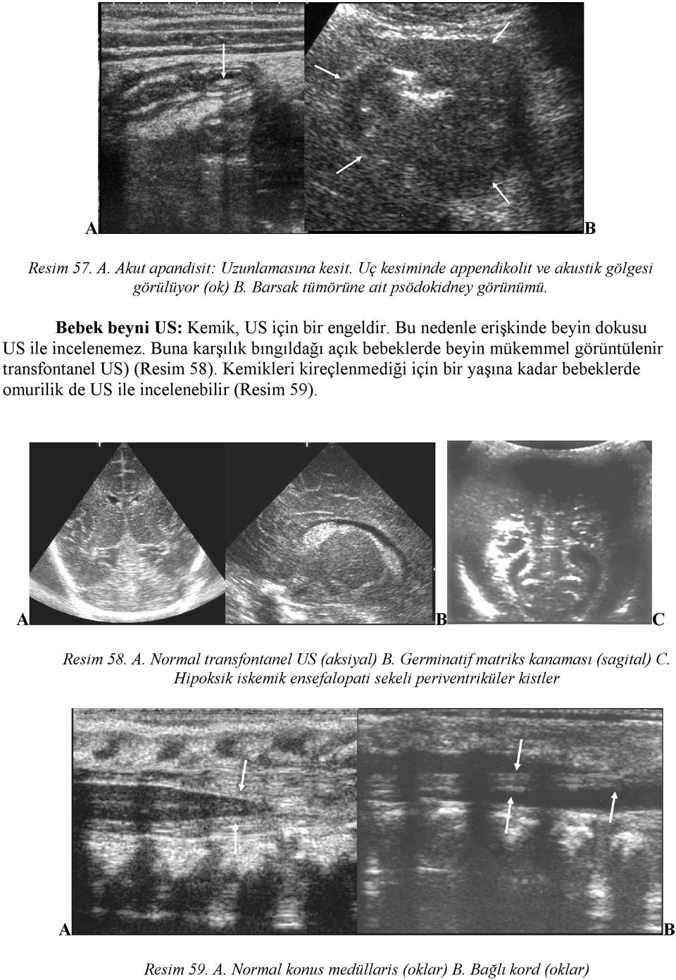 Buna karşılık bıngıldağı açık bebeklerde beyin mükemmel görüntülenir transfontanel US) (Resim 58).