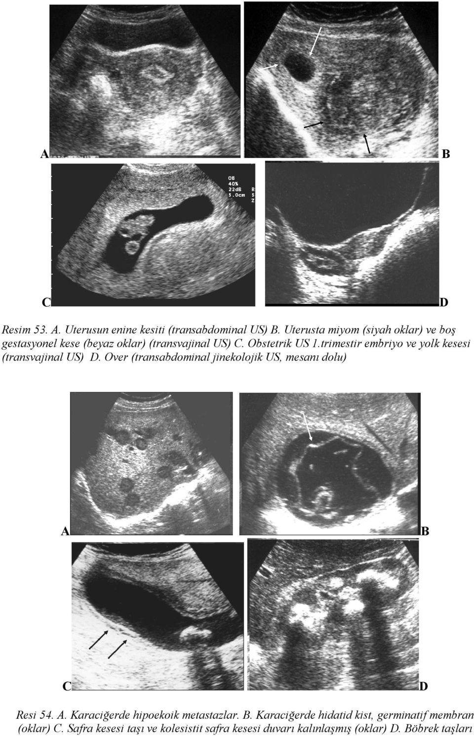 trimestir embriyo ve yolk kesesi (transvajinal US) D.