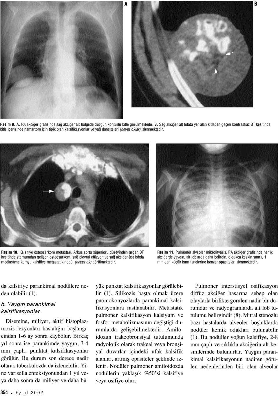 Kalsifiye osteosarkom metastaz.