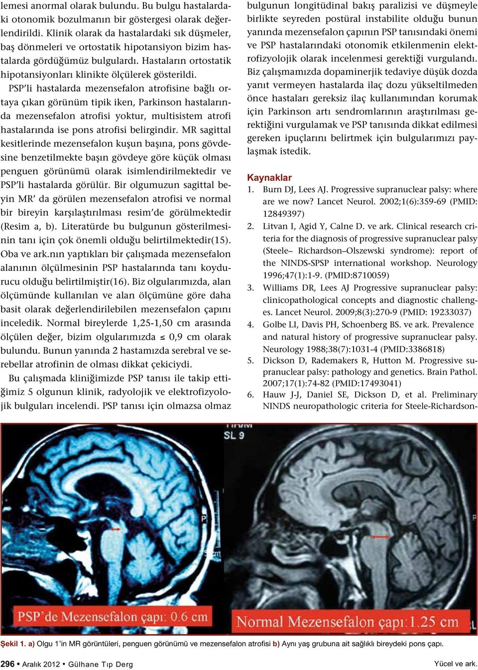 PSP li hastalarda mezensefalon atrofisine bağlı ortaya çıkan görünüm tipik iken, Parkinson hastalarında mezensefalon atrofisi yoktur, multisistem atrofi hastalarında ise pons atrofisi belirgindir.