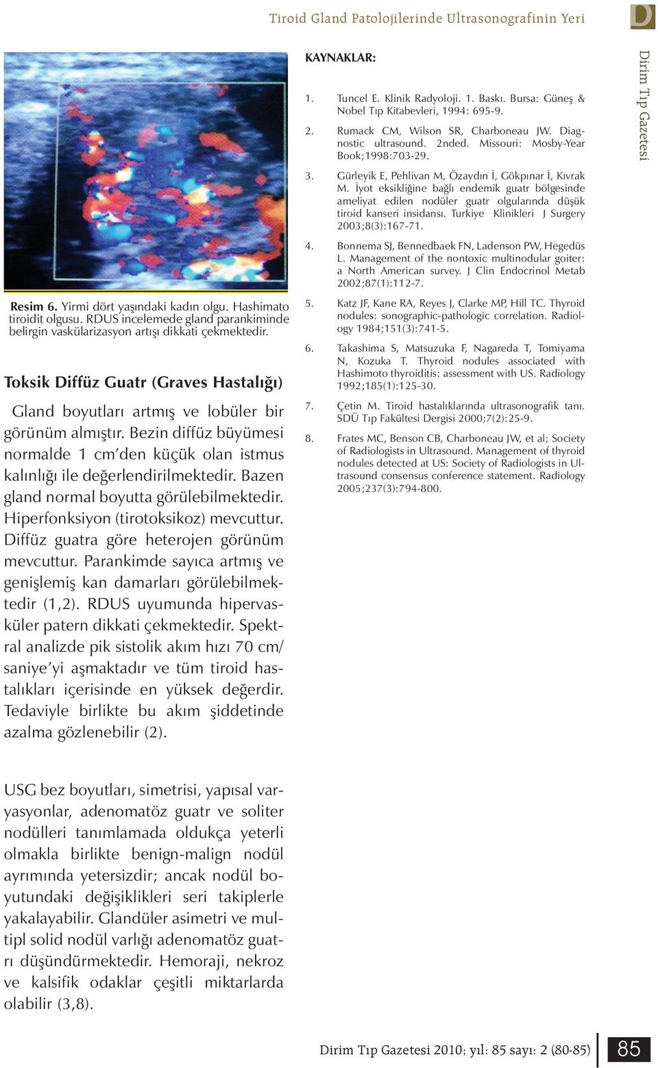 Bezin diffüz büyümesi normalde 1 cm den küçük olan istmus kalınlığı ile değerlendirilmektedir. Bazen gland normal boyutta görülebilmektedir. Hiperfonksiyon (tirotoksikoz) mevcuttur.