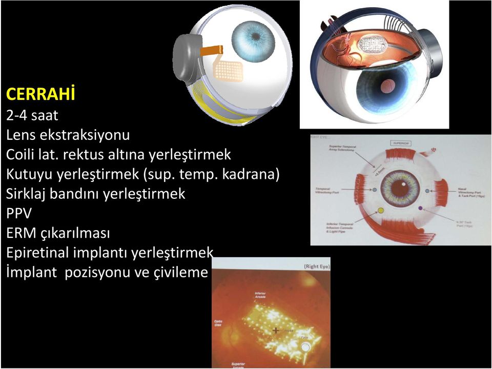 temp. kadrana) Sirklaj bandını yerleştirmek PPV ERM