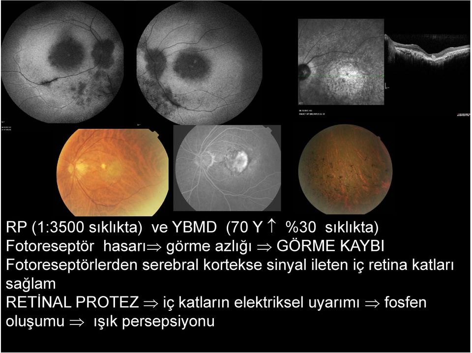 kortekse sinyal ileten iç retina katları sağlam RETİNAL PROTEZ