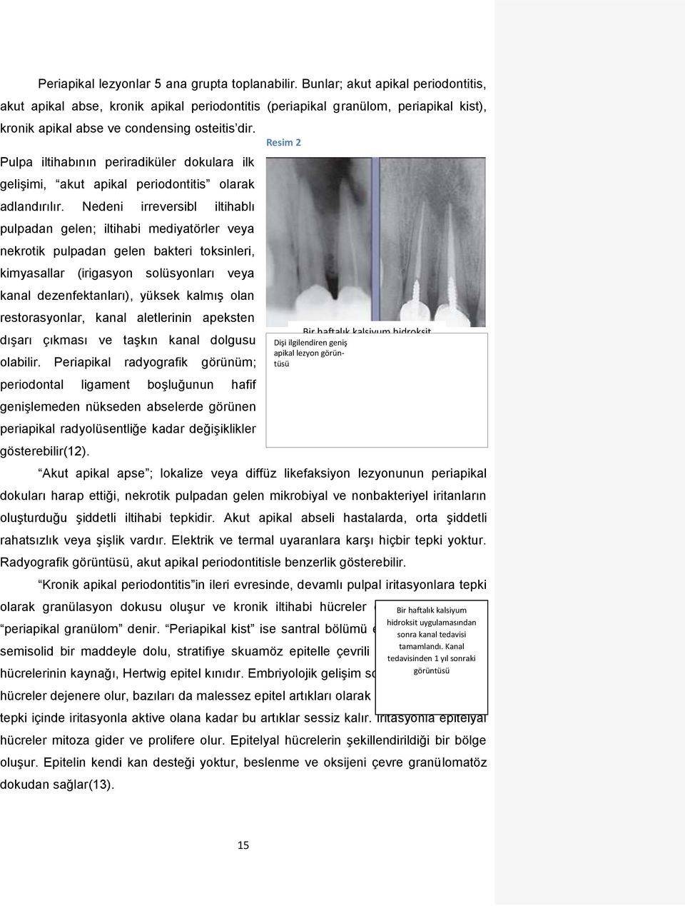 Pulpa iltihabının periradiküler dokulara ilk gelişimi, akut apikal periodontitis olarak adlandırılır.