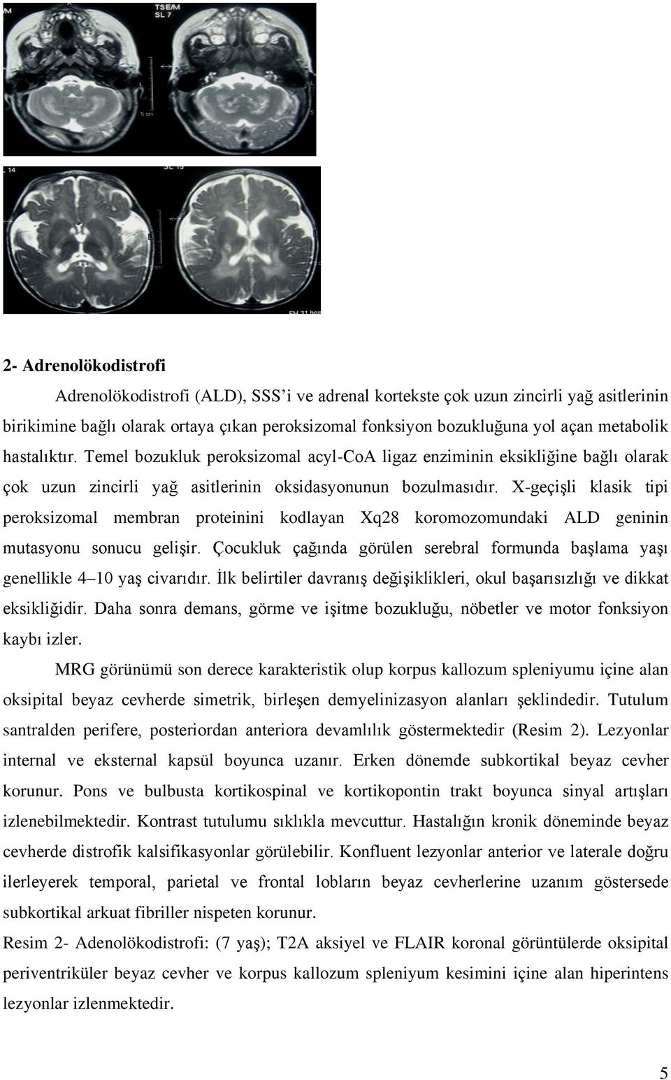 X-geçişli klasik tipi peroksizomal membran proteinini kodlayan Xq28 koromozomundaki ALD geninin mutasyonu sonucu gelişir.