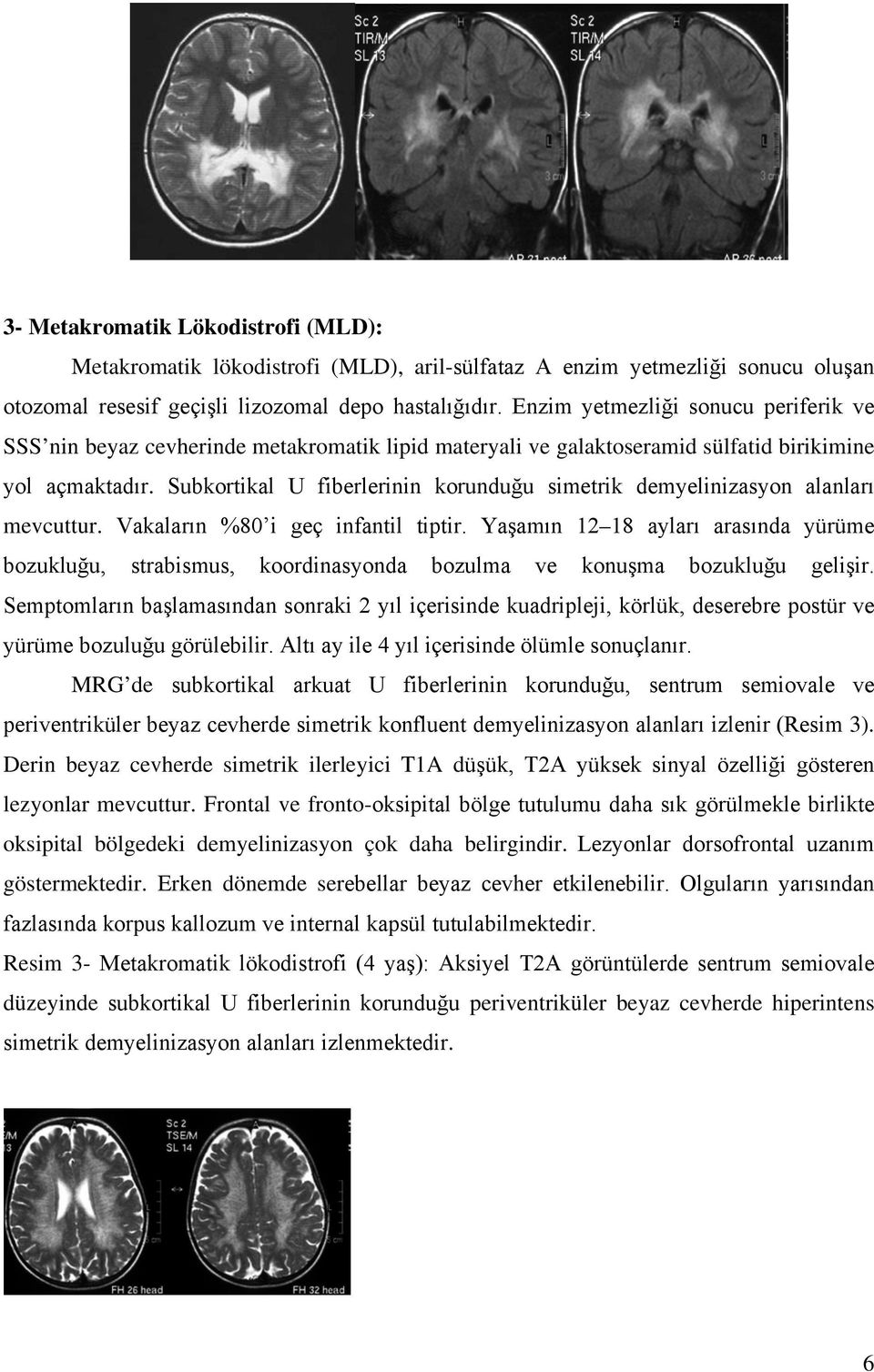 Subkortikal U fiberlerinin korunduğu simetrik demyelinizasyon alanları mevcuttur. Vakaların %80 i geç infantil tiptir.