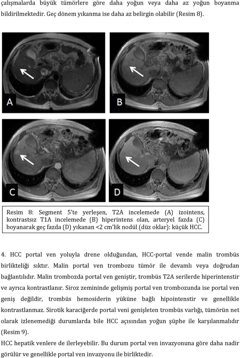 HCC. 4. HCC portal ven yoluyla drene olduğundan, HCC portal vende malin trombüs birlikteliği sıktır. Malin portal ven trombozu tümör ile devamlı veya doğrudan bağlantılıdır.