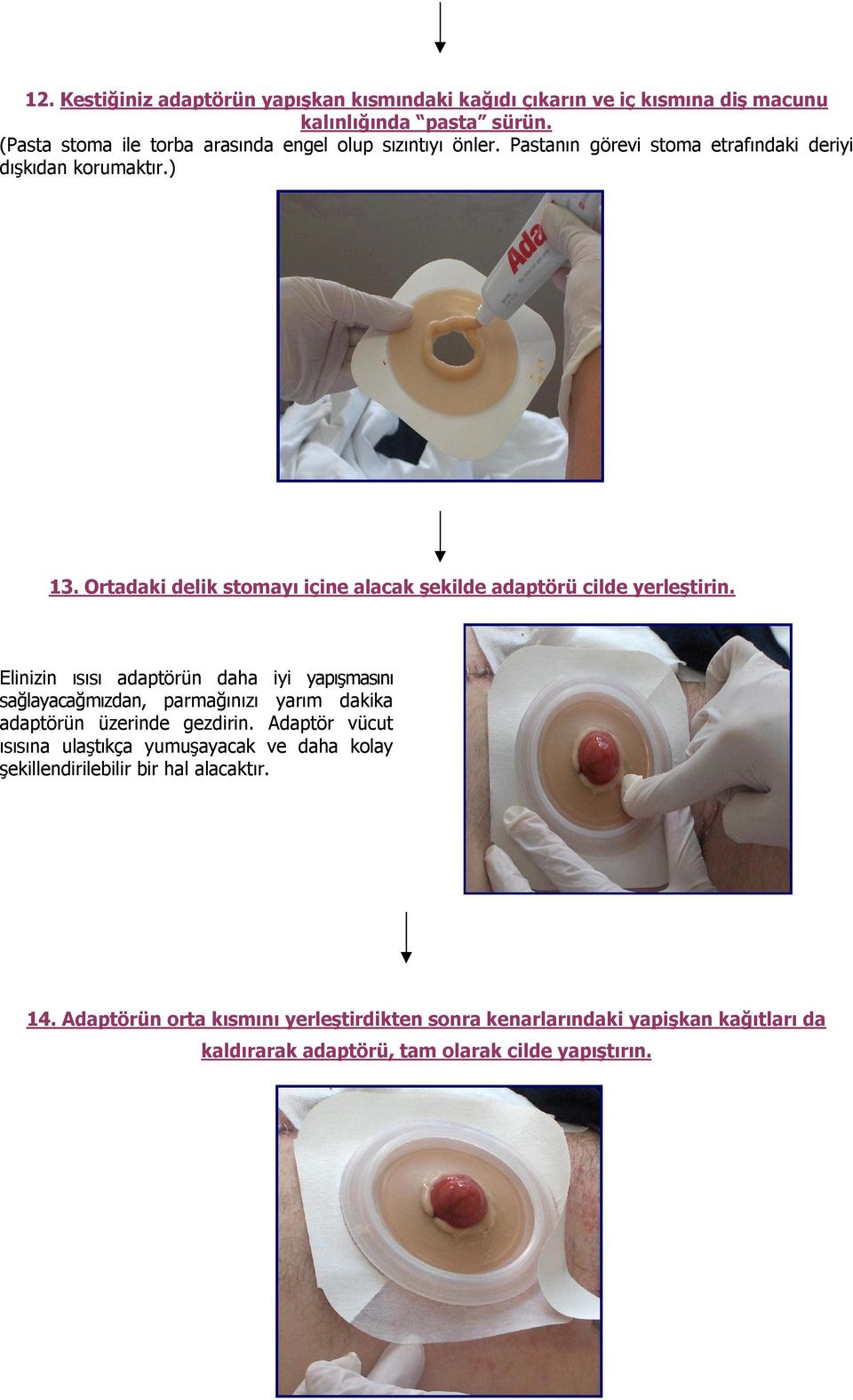 Ortadaki delik stomayı içine alacak şekilde adaptörü cilde yerleştirin.