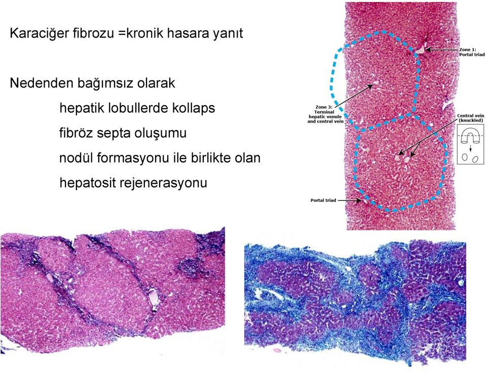 lobullerde kollaps fibröz septa oluşumu