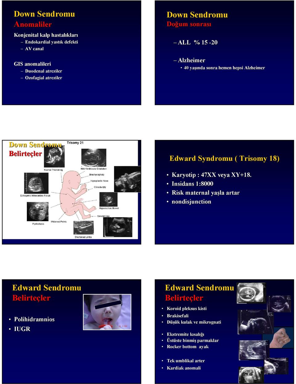 Insidans 1:8000 Risk maternal yaşla artar nondisjunction Edward SendromS Belirteç Polihidramnios IUGR Edward SendromS Belirteç Koroid pleksus kisti