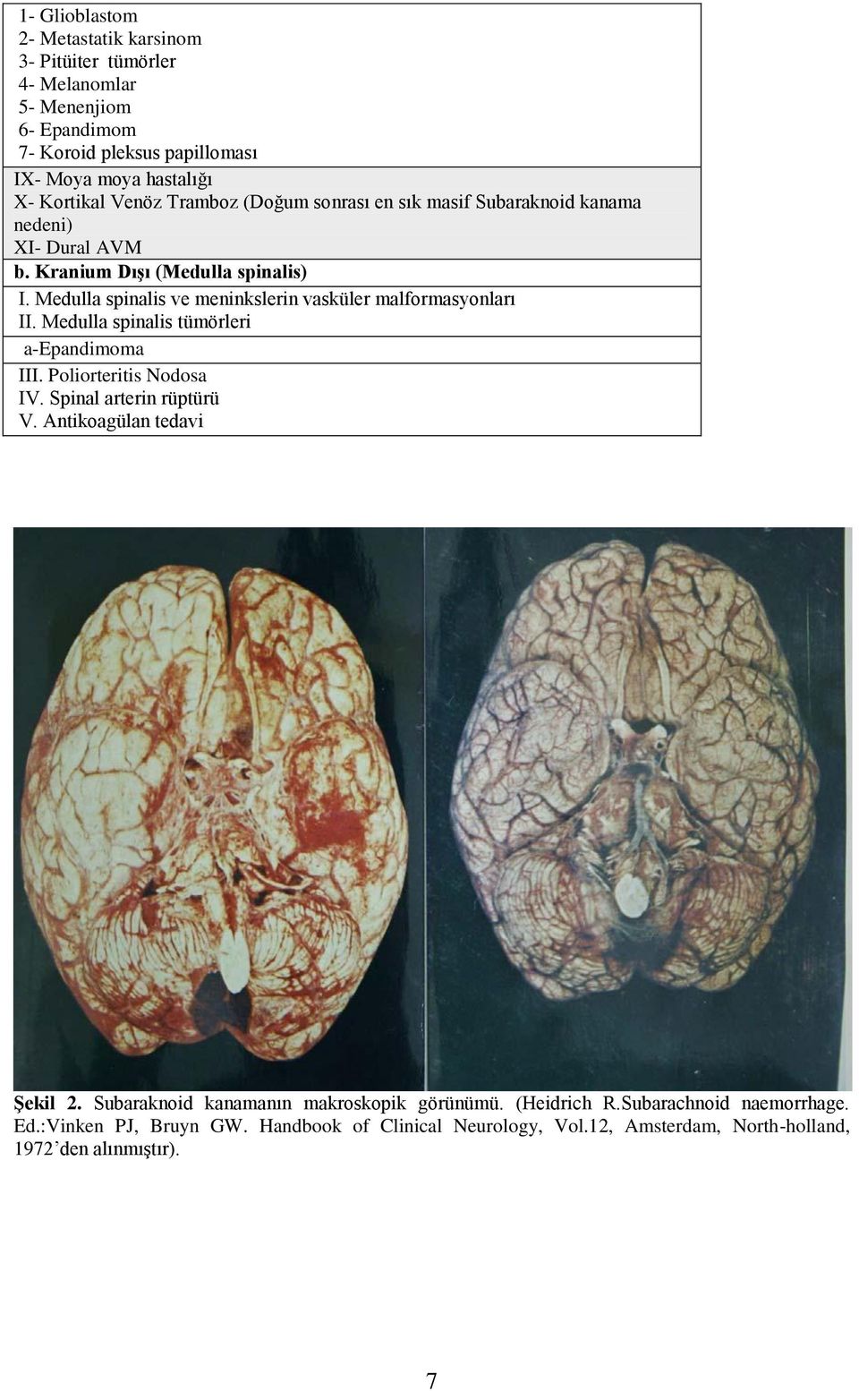 Medulla spinalis ve meninkslerin vasküler malformasyonları II. Medulla spinalis tümörleri a-epandimoma III. Poliorteritis Nodosa IV. Spinal arterin rüptürü V.