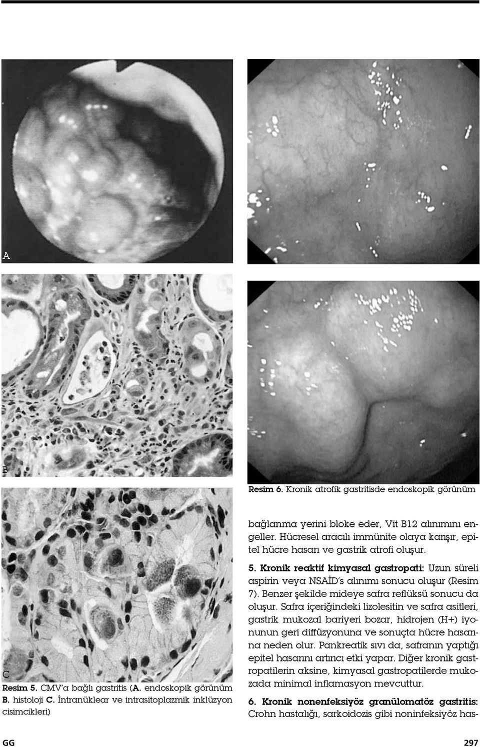 İntranüklear ve intrasitoplazmik inklüzyon cisimcikleri) 5. Kronik reaktif kimyasal gastropati: Uzun süreli aspirin veya NSAİD s alınımı sonucu oluşur (Resim 7).