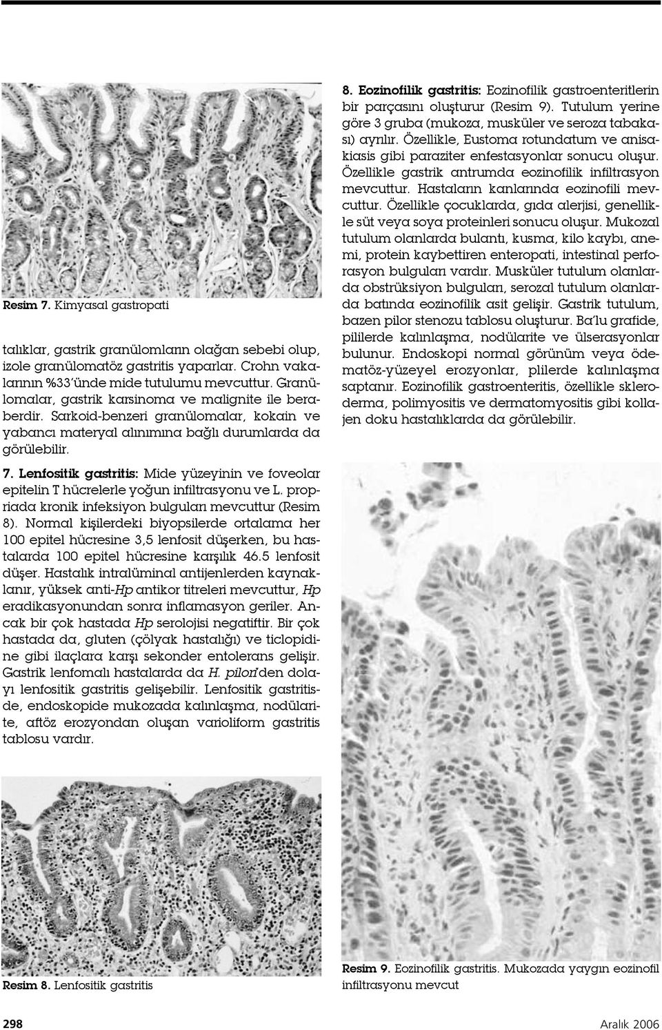 Lenfositik gastritis: Mide yüzeyinin ve foveolar epitelin T hücrelerle yoğun infiltrasyonu ve L. propriada kronik infeksiyon bulguları mevcuttur (Resim 8).