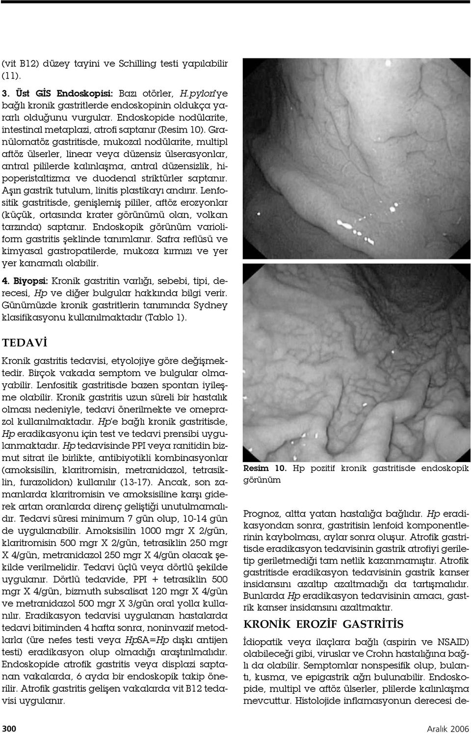 Granülomatöz gastritisde, mukozal nodülarite, multipl aftöz ülserler, linear veya düzensiz ülserasyonlar, antral pililerde kalınlaşma, antral düzensizlik, hipoperistaltizma ve duodenal striktürler