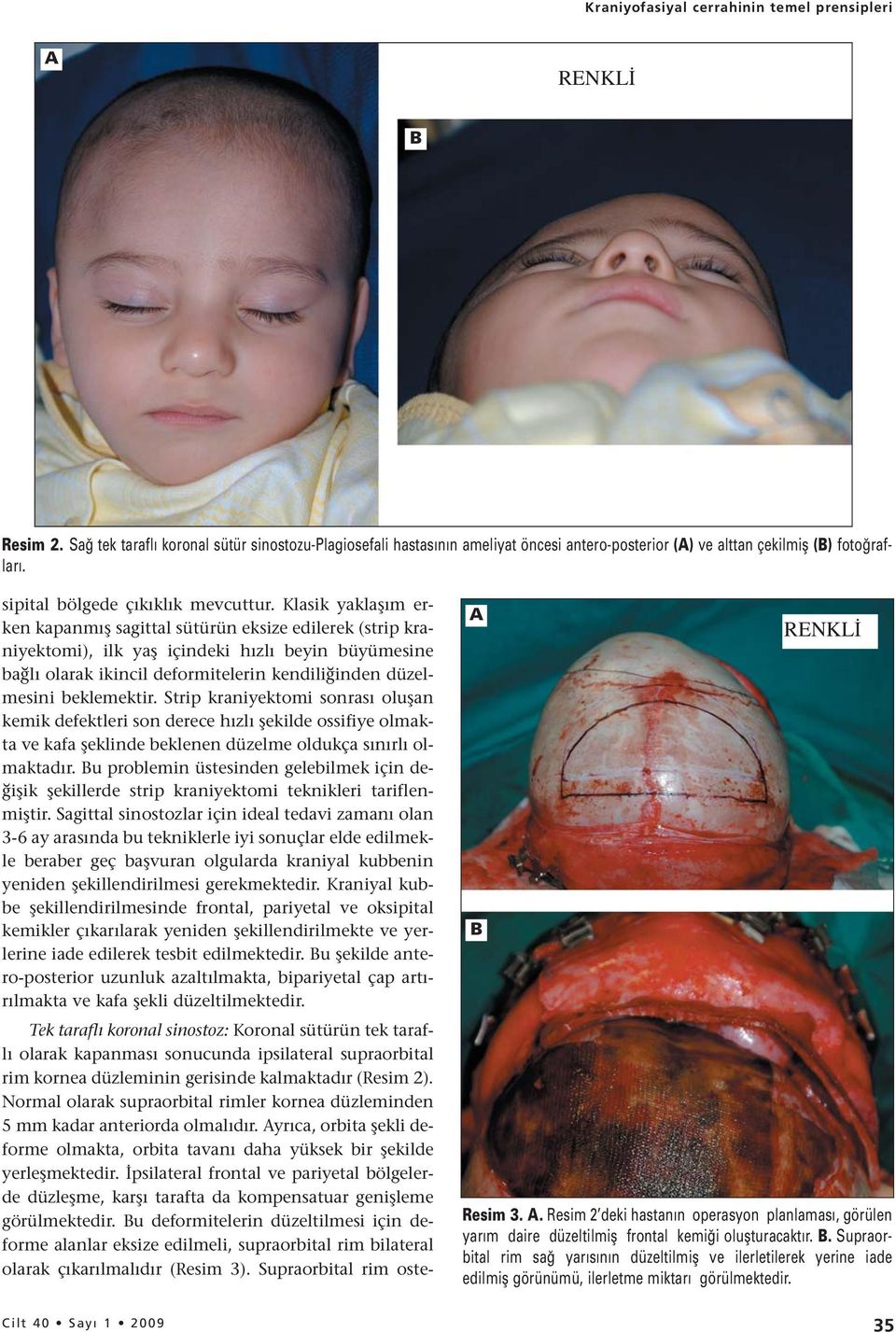 Klasik yaklaşım erken kapanmış sagittal sütürün eksize edilerek (strip kraniyektomi), ilk yaş içindeki hızlı beyin büyümesine bağlı olarak ikincil deformitelerin kendiliğinden düzelmesini beklemektir.