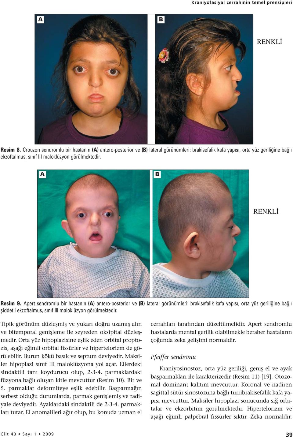 pert sendromlu bir hastanın () antero-posterior ve () lateral görünümleri: brakisefalik kafa yapısı, orta yüz geriliğine bağlı şiddetli ekzoftalmus, sınıf III maloklüzyon görülmektedir.