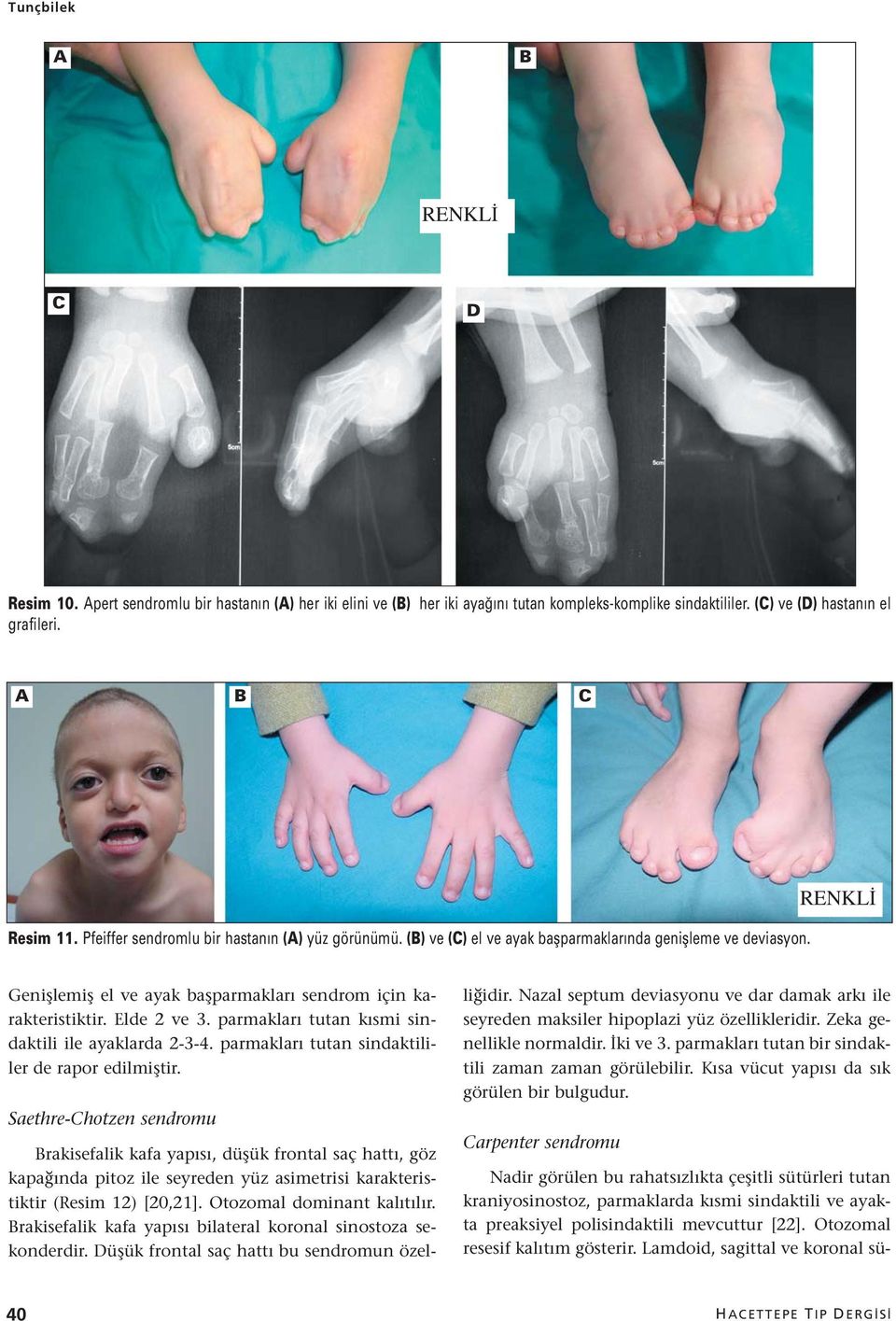parmakları tutan kısmi sindaktili ile ayaklarda 2-3-4. parmakları tutan sindaktililer de rapor edilmiştir.
