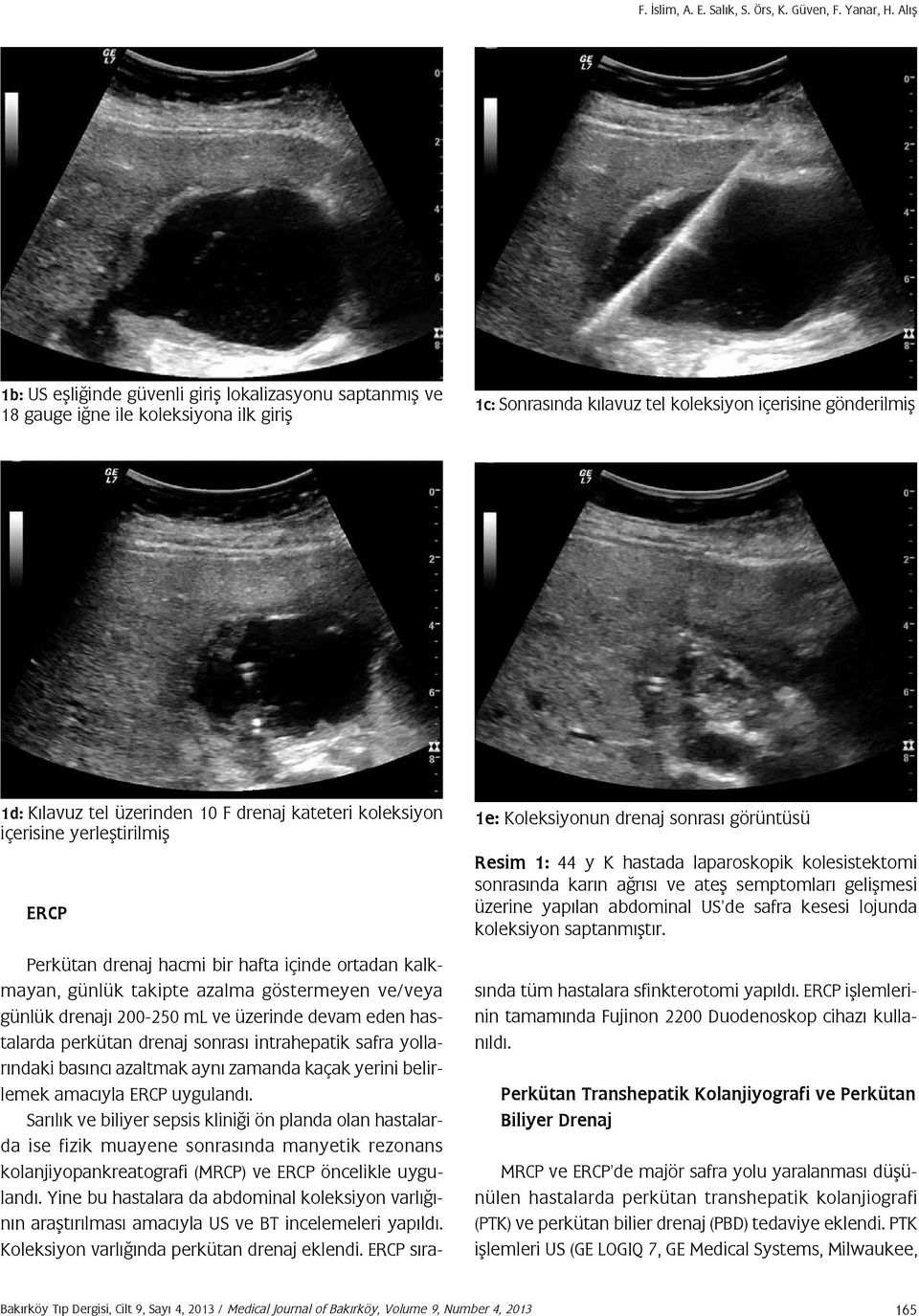 drenaj kateteri koleksiyon içerisine yerleştirilmiş ERCP 1e: Koleksiyonun drenaj sonrası görüntüsü Resim 1: 44 y K hastada laparoskopik kolesistektomi sonrasında karın ağrısı ve ateş semptomları