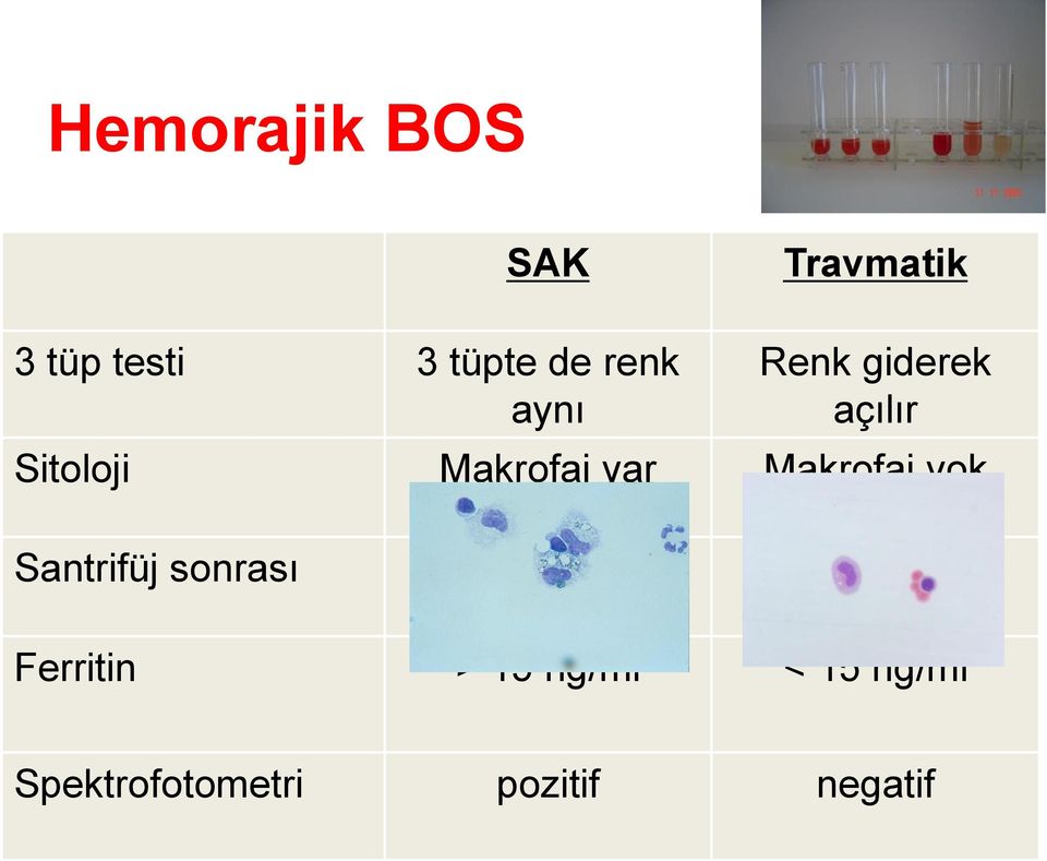 Makrofaj yok Santrifüj sonrası ksantokromik berrak