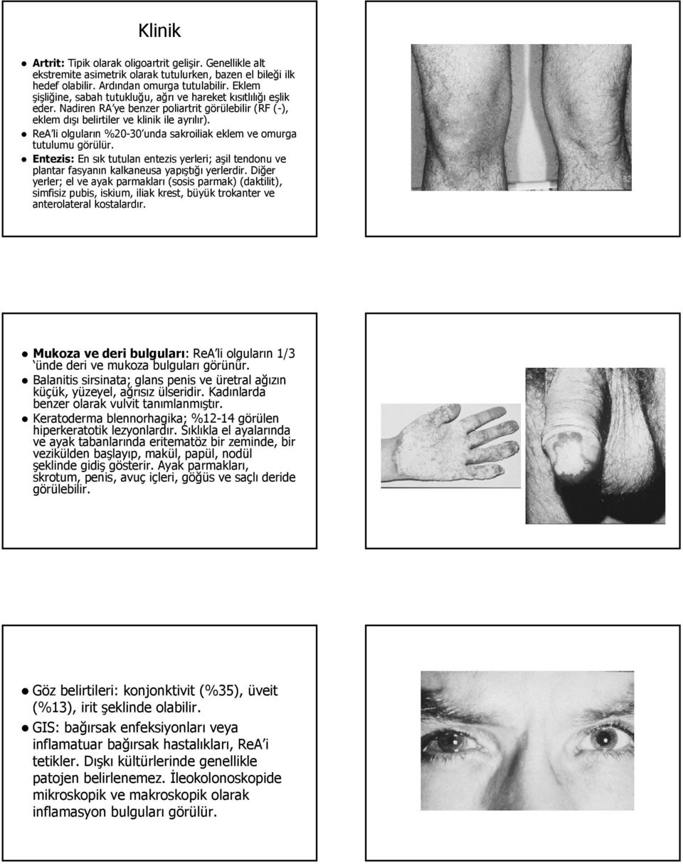 ReA li olguların %20-30 unda sakroiliak eklem ve omurga tutulumu görülür. Entezis: En sık tutulan entezis yerleri; aşil tendonu ve plantar fasyanın kalkaneusa yapıştığı yerlerdir.