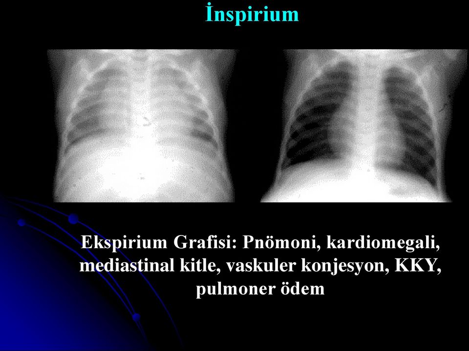 kardiomegali, mediastinal