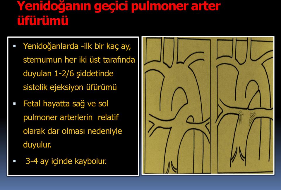 sistolik ejeksiyon üfürümü Fetal hayatta sağ ve sol pulmoner