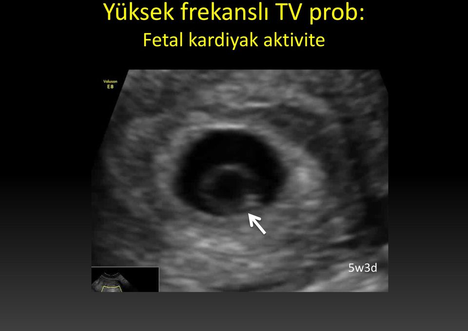prob: Fetal