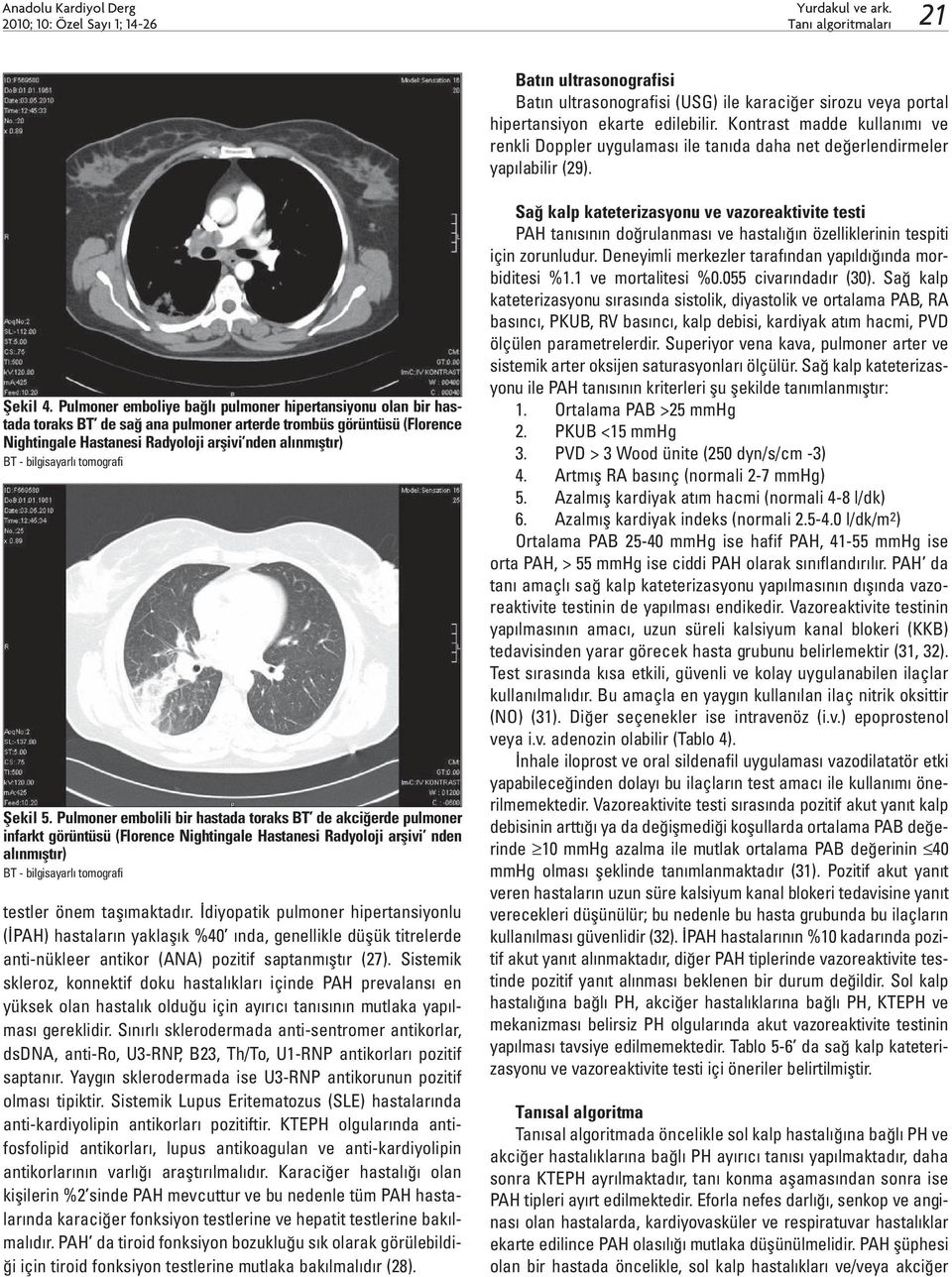 Pulmoner emboliye bağlı pulmoner hipertansiyonu olan bir hastada toraks BT de sağ ana pulmoner arterde trombüs görüntüsü (Florence Nightingale Hastanesi Radyoloji arşivi nden alınmıştır) BT -