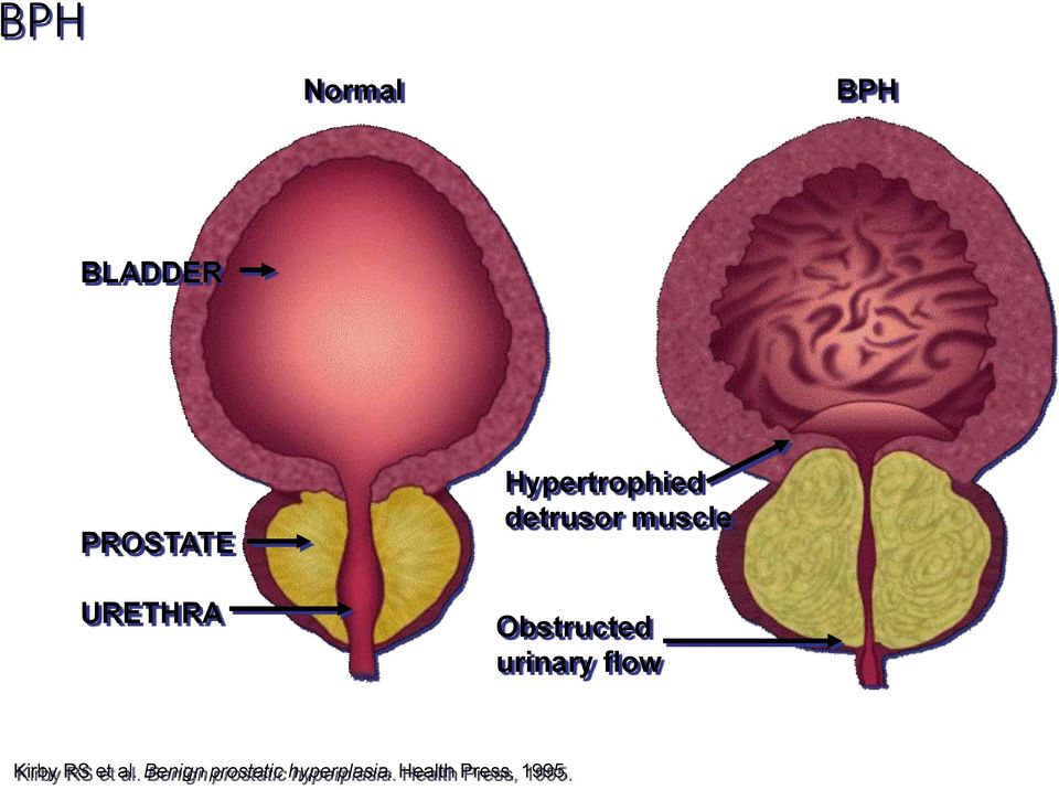 Obstructed urinary flow Kirby RS et al.