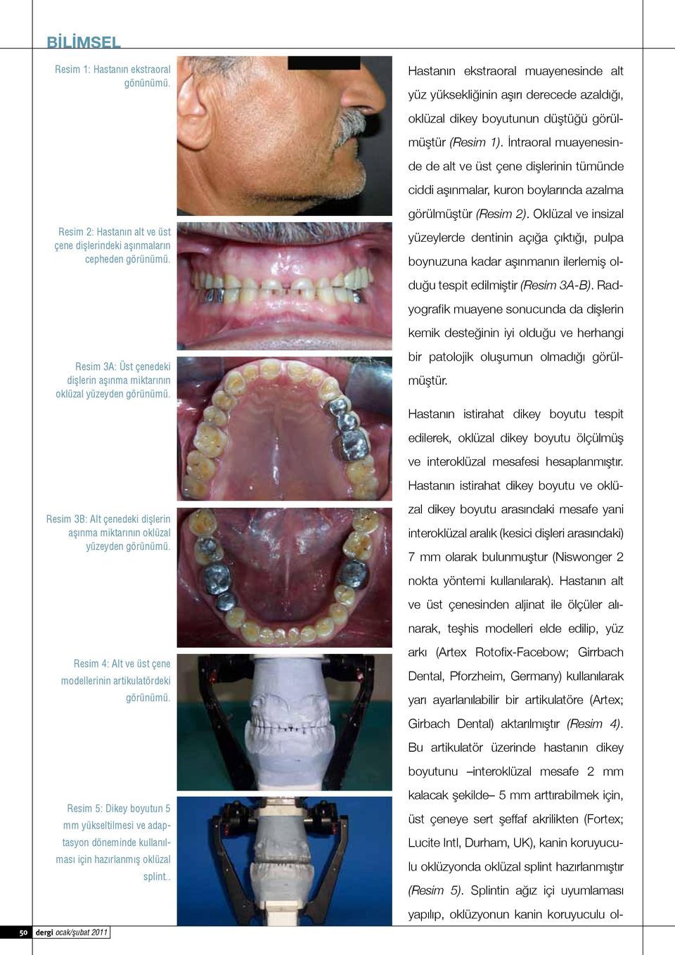 yüzeyden Resim 5: Dikey boyutun 5 mm yükseltilmesi ve adaptasyon döneminde kullanılması için hazırlanmış oklüzal dergi ocak/şubat 2011 Resim 4: Alt ve üst çene modellerinin artikulatördeki splint.