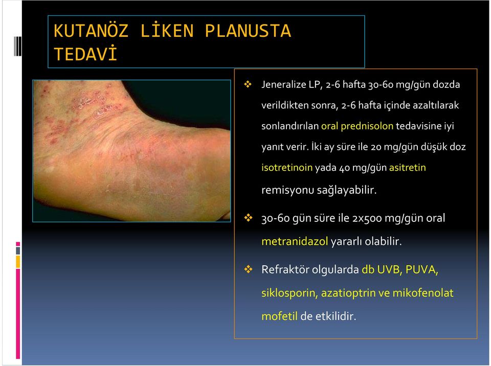 İki ay süre ile 20 mg/gün düşük doz isotretinoin yada 40 mg/gün asitretin remisyonu sağlayabilir.