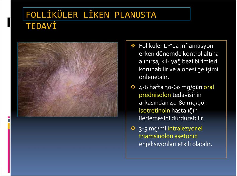 4-6 hafta 30-60 mg/gün oral prednisolontedavisinin arkasından 40-80 mg/gün isotretinoin