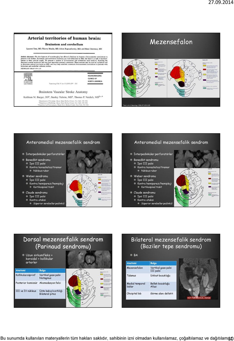 Weber sendromu İpsi III palsi Kontra hemiparezi/hemipleji Kortikospinal trakt Claude sendromu İpsi III palsi Kontra ataksi Süperior serebellar pedinkül İnterpedinküler perforatörler Benedikt sendromu