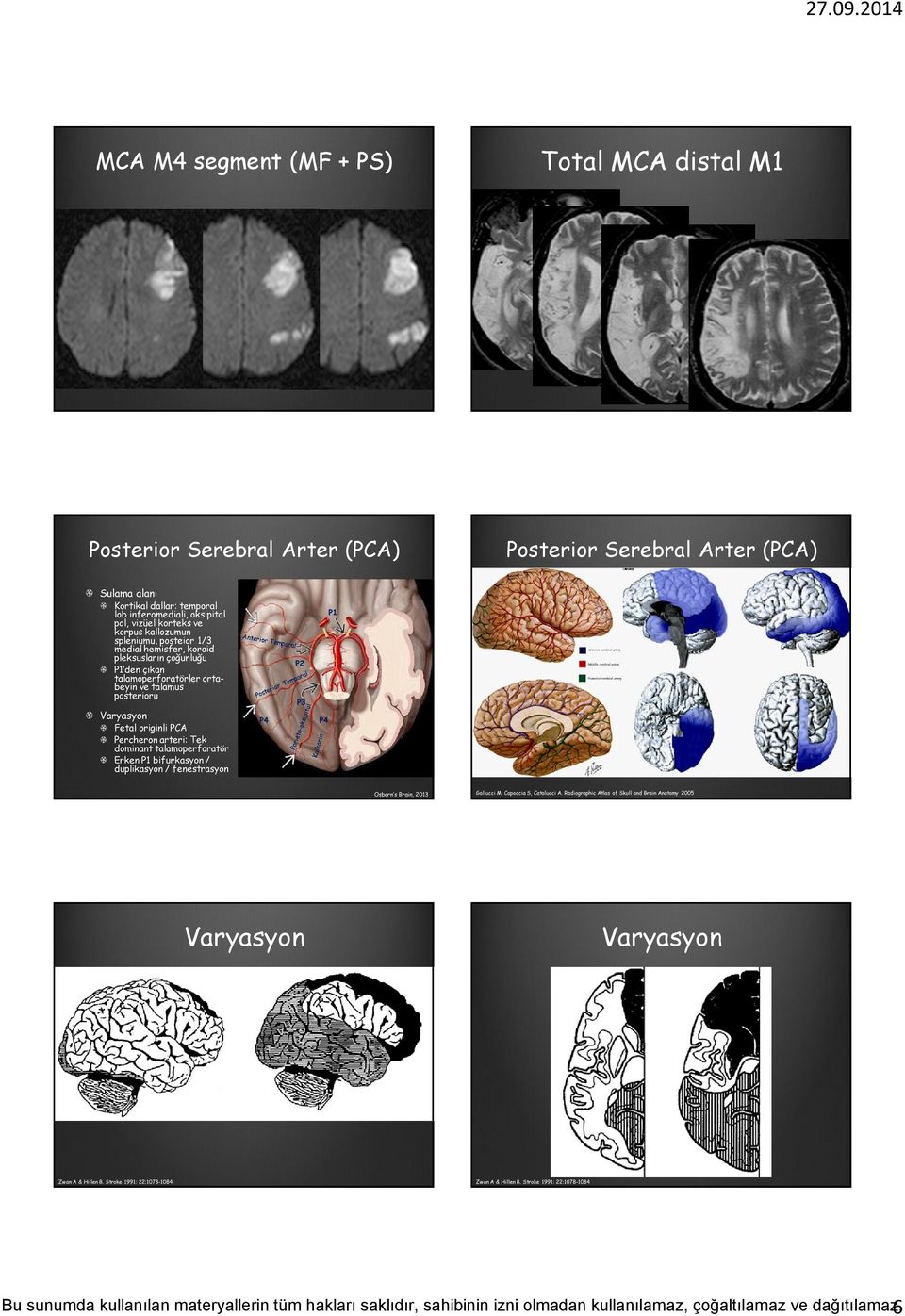 çıkan talamoperforatörler ortabeyin ve talamus posterioru Fetal originli PCA Percheron arteri: Tek dominant talamoperforatör Erken P1 bifurkasyon