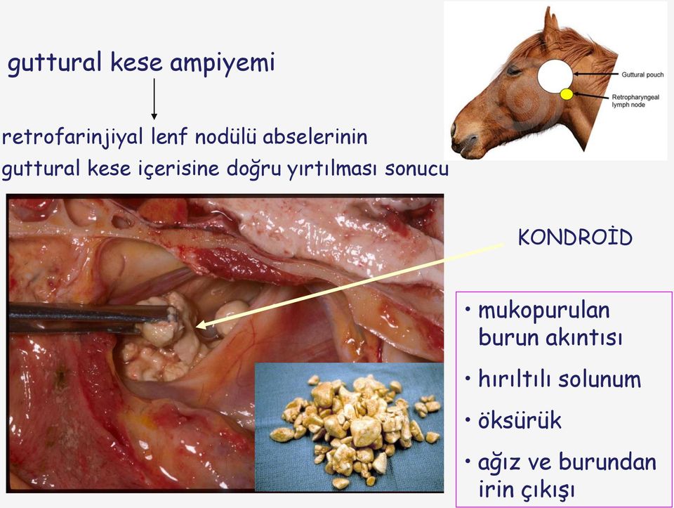 yırtılması sonucu KONDROİD mukopurulan burun