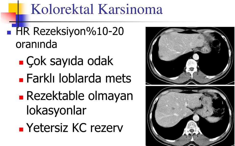 sayıda odak Farklı loblarda mets