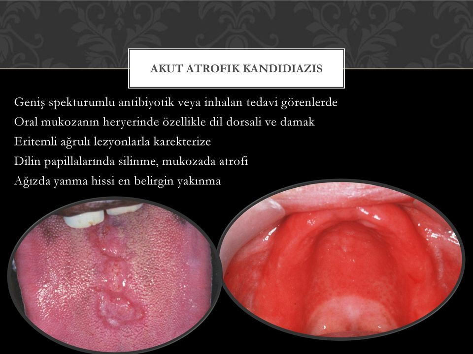 dorsali ve damak Eritemli ağrulı lezyonlarla karekterize Dilin