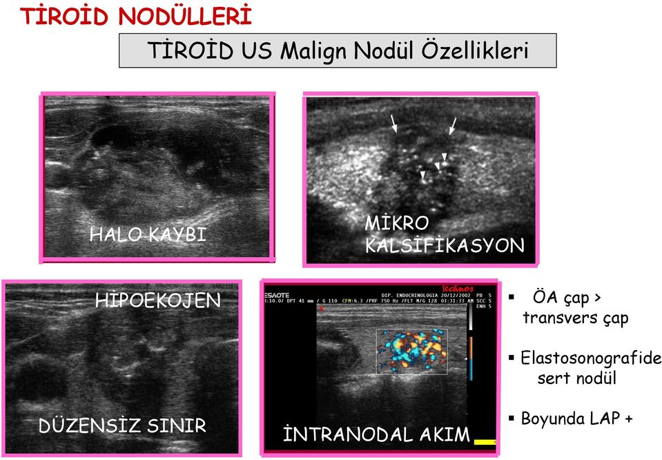 > transvers çap Elastosonografide sert