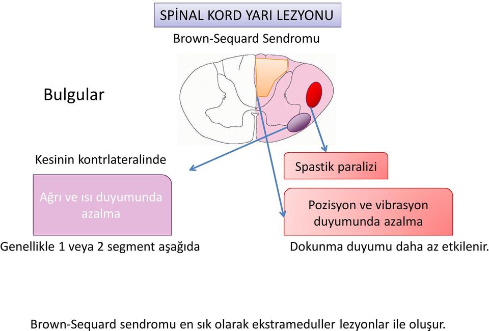 aşağıda Spastik paralizi Pozisyon ve vibrasyon duyumunda azalma Dokunma