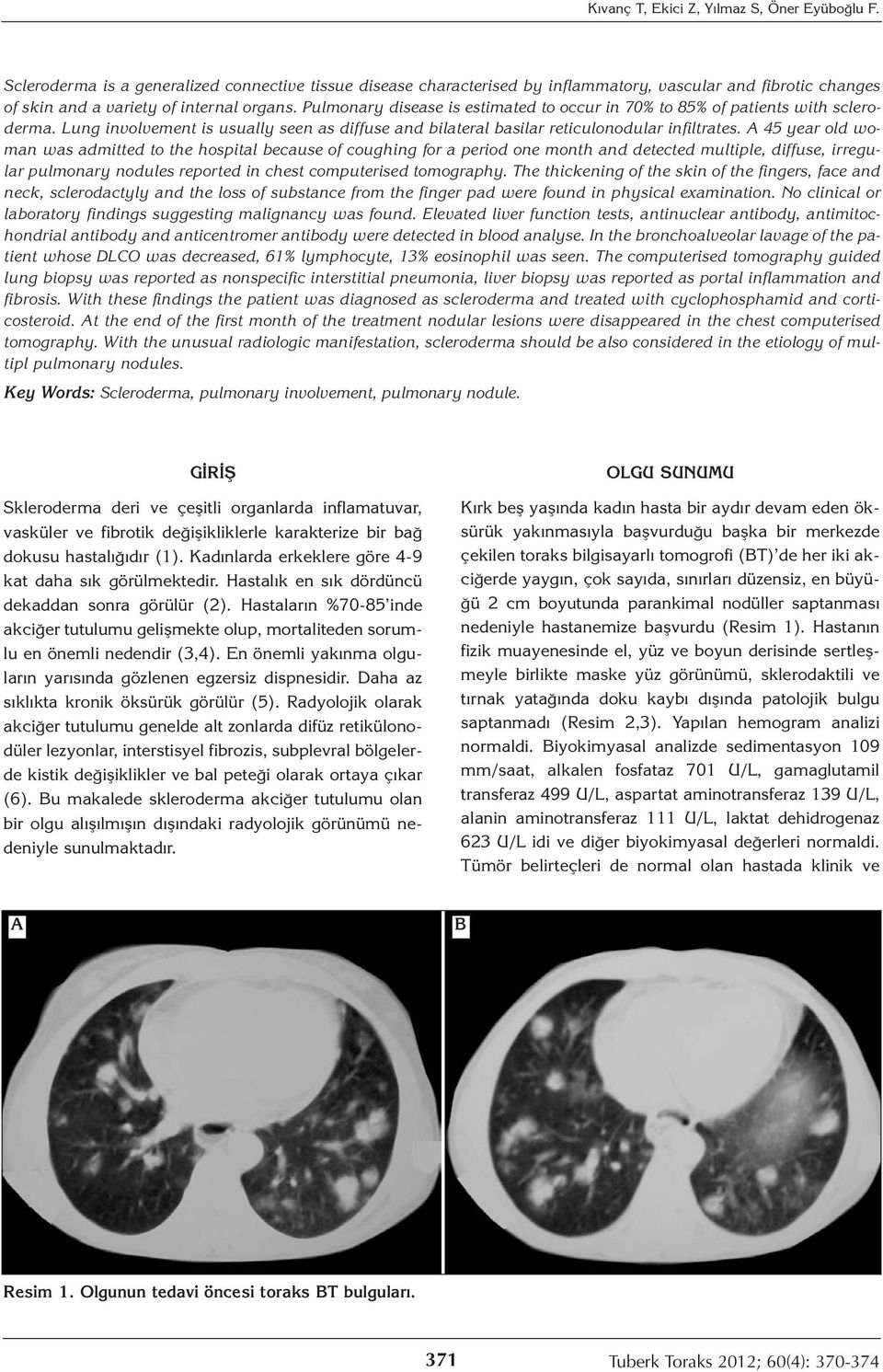 Pulmonary disease is estimated to occur in 70% to 85% of patients with scleroderma. Lung involvement is usually seen as diffuse and bilateral basilar reticulonodular infiltrates.