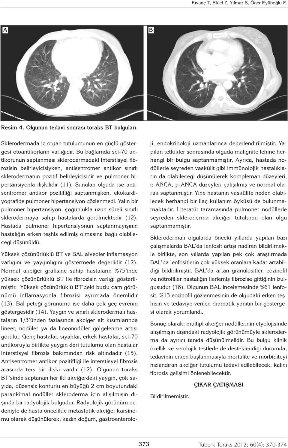 ilişkilidir (11). Sunulan olguda ise antisentromer antikor pozitifliği saptanmışken, ekokardiyografide pulmoner hipertansiyon gözlenmedi.