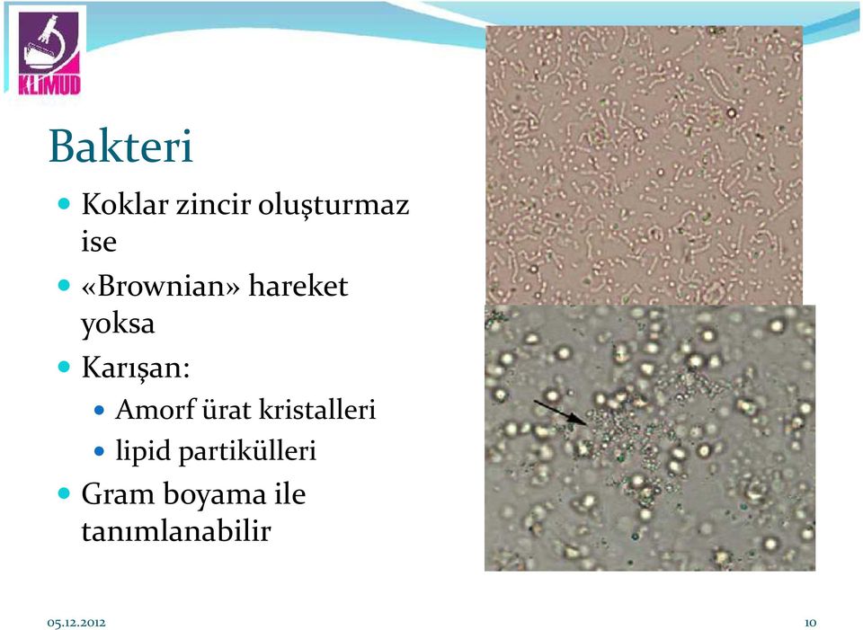 ürat kristalleri lipid partikülleri