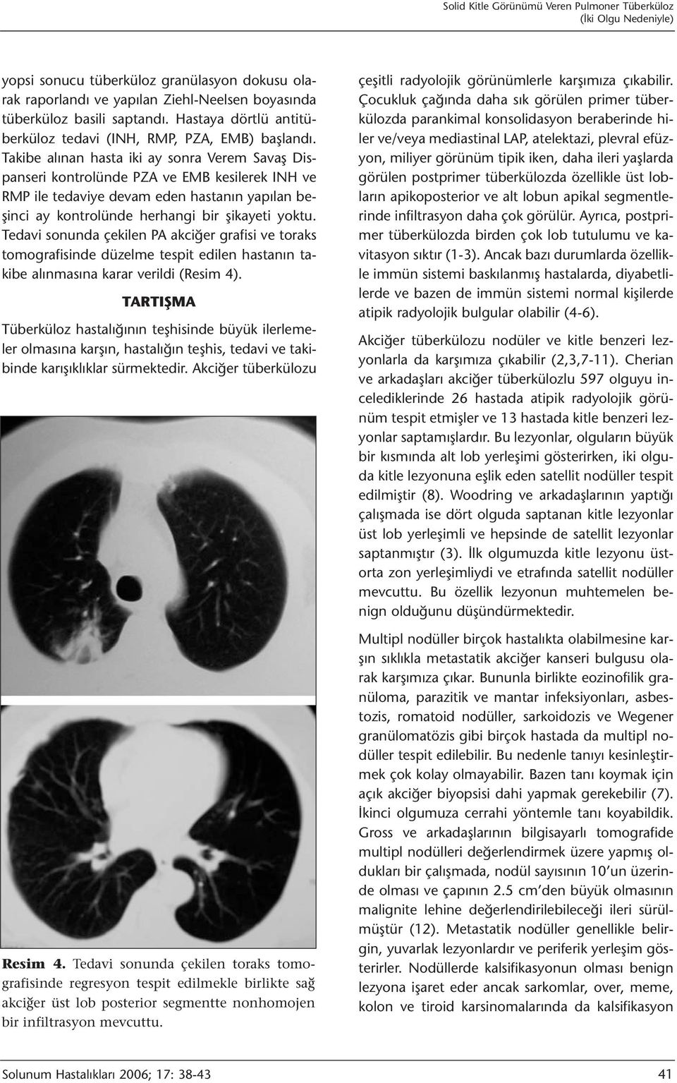 Takibe alınan hasta iki ay sonra Verem Savaş Dispanseri kontrolünde PZA ve EMB kesilerek INH ve RMP ile tedaviye devam eden hastanın yapılan beşinci ay kontrolünde herhangi bir şikayeti yoktu.