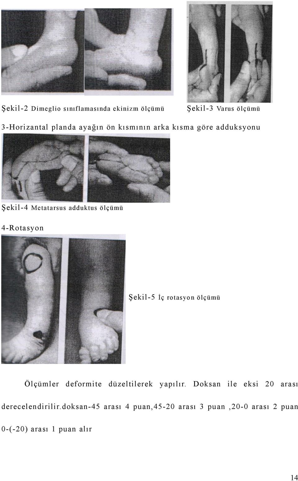 4-Rotasyon Şekil-5 İç rot as yo n öl çüm ü Ölçümler deformite düzeltilerek yapılır.