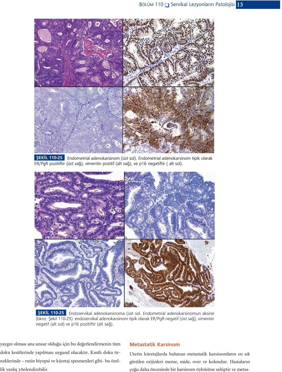 Endometrial adenokarsinomun aksine (bknz. fiekil 110-25) endoservikal adenokarsinom tipik olarak ER/PgR negatif (üst sa ), vimentin negatif (alt sol) ve p16 pozitiftir (alt sa ).