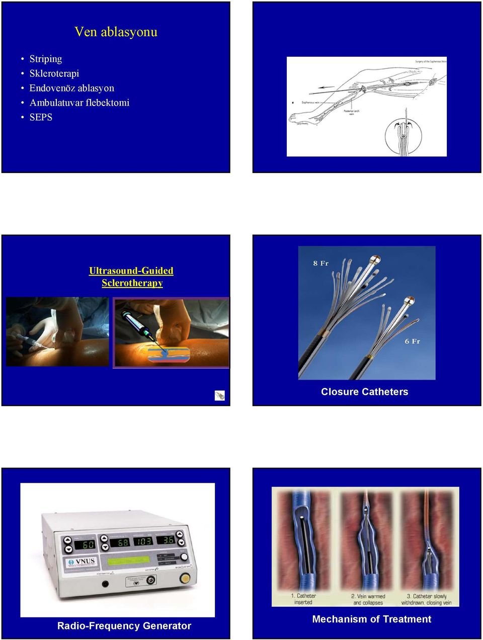 Ultrasound-Guided Sclerotherapy Closure